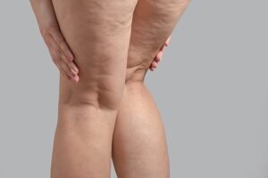 Lipedema