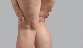 Lipedema