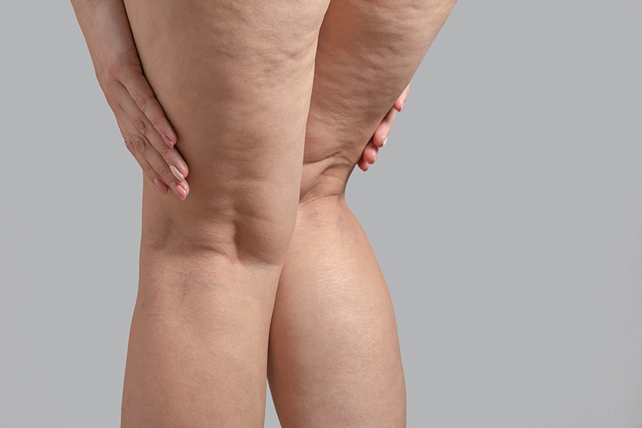 Lipedema